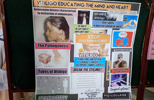 World Vitiligo Day
